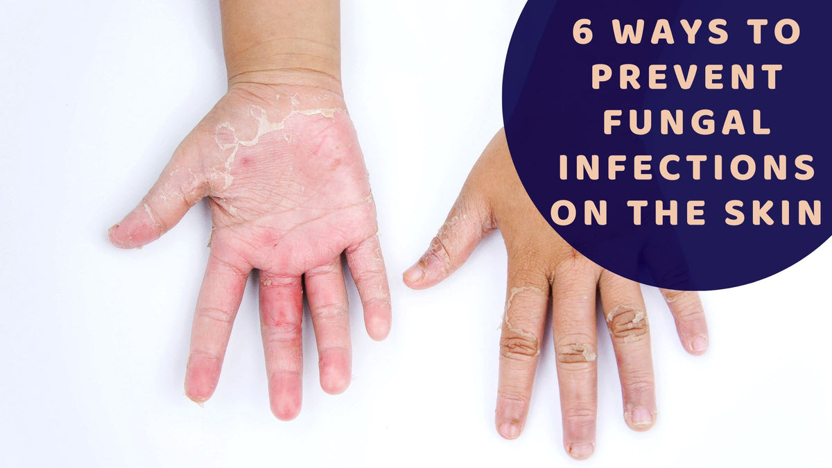 FInd out the risk factors and how to prevent skin's fungal